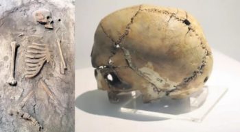 Aşıklı Höyük tarihte bilinen ilk beyin ameliyatının yapıldığı yer