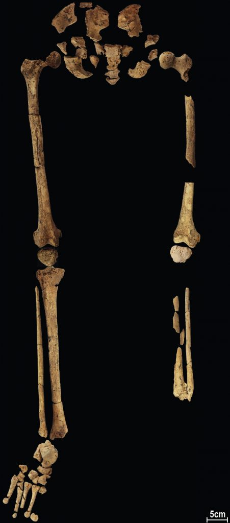 Endonezya'da bir mağarada bulunan 31.000 yıllık iskelet amputasyonun bilinen en eski kanıtı olabilir