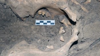 Amarna Yeni Krallık mezarlığında genç bir kadına ait teratom bulundu