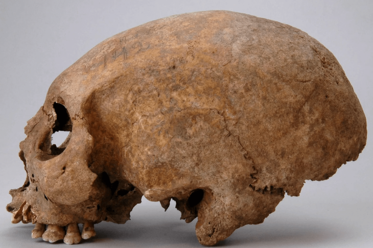 Viking Kadınlarında Keşfedilen Üç Garip Kafatası Modifikasyonu